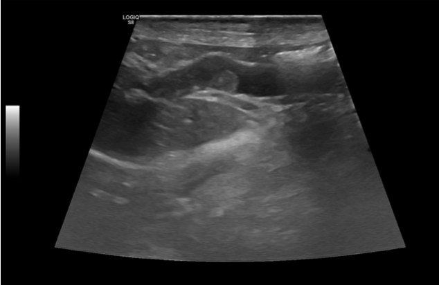 Fig. 3 - Immagine ecografica da un cane con PLE che mostra presenza di un trombo all’interno della vena porta. Image