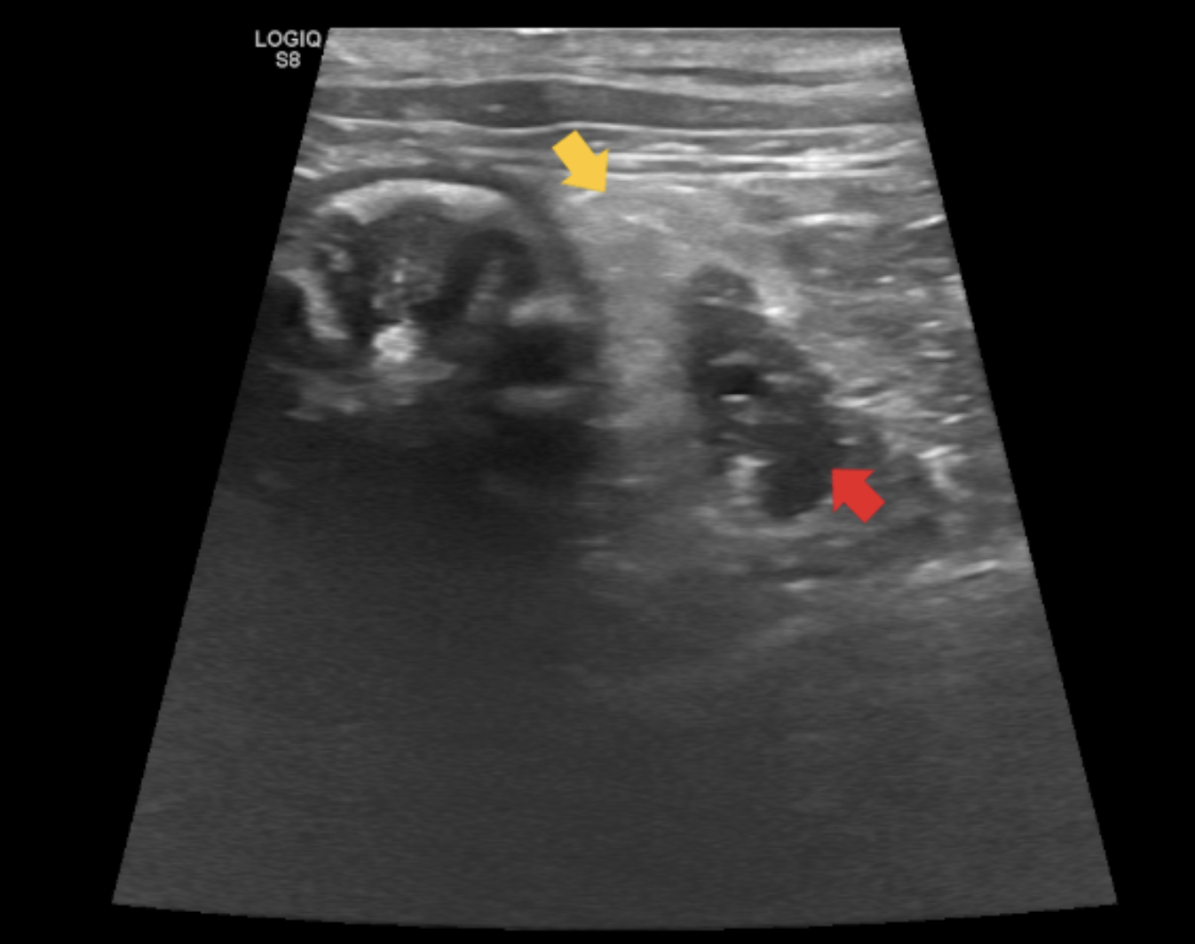 Figura 2 - Immagine ecografica di pancreatite acuta nel gatto. È presente reattività del grasso circostante il pancreas (freccia gialla). Quest’ultimo appare aumentato di volume e edematoso (freccia rossa). Image