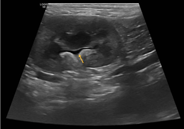 Fig. 3 - Immagine ecografica di un gatto con malattia renale cronica dove si apprezza, tra i rilievi principali, una lieve dilatazione del bacinetto renale compatibile con una infezione batterica renale (pielonefrite). Image