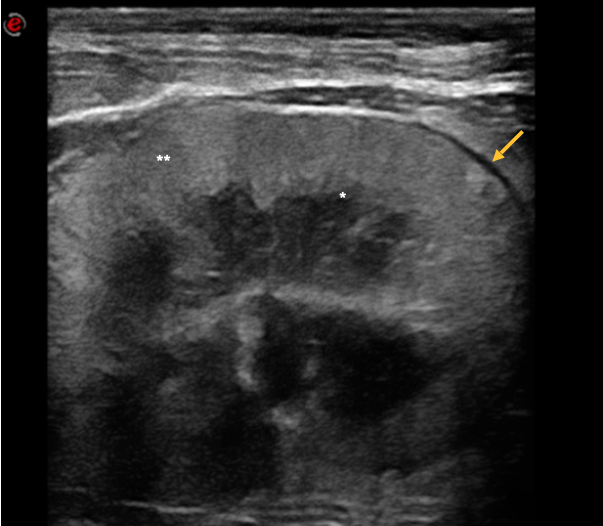 Fig. 2 - Ecografia di un gatto con malattia renale cronica avanzata. Si noti la perdita della normale distinzione cortico-midollare (*), l’aspetto irregolare del profilo renale (**) e la lieve quantità di versamento perirenale (freccia). Image