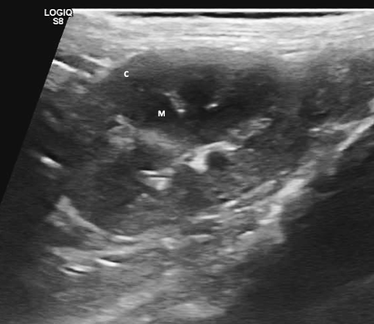 Fig. 1 - Immagine ecografica di un rene normale in cui è possibile la parte esterna (corticale, C) dalla parte interna (midollare, M) Image