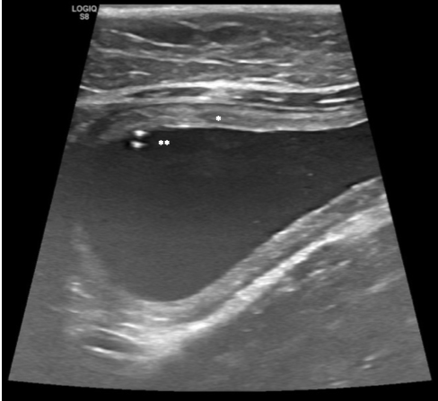 Fig.1 - Immagine ecografica della vescica urinaria di un gatto con ostruzione uretrale, eseguita dopo disostruzione per cateterismo. Si noti l’ispessimento della parete della vescica (*) indicativo di una concomitante infiammazione della vescica, e la presenza dei 2 piccoli calcoli che sono stati sospinti dall’uretra all’interno della vescica (**) tramite cateterismo e idropulsione. Image