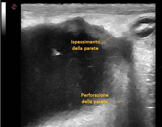 Fig. 2 - Colecisti gravemente sovradistesa in un cane con colecistite batterica. Si noti l’ispessimento della parete con aspetto disomogeneo con sospetta perforazione della parete (*). Image