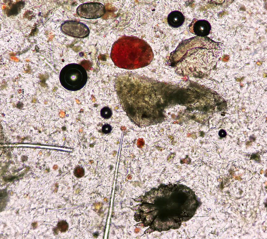 Fig.3: Raschiato cutaneo superficiale: adulto e uova di Sarcoptes scabiei. Image