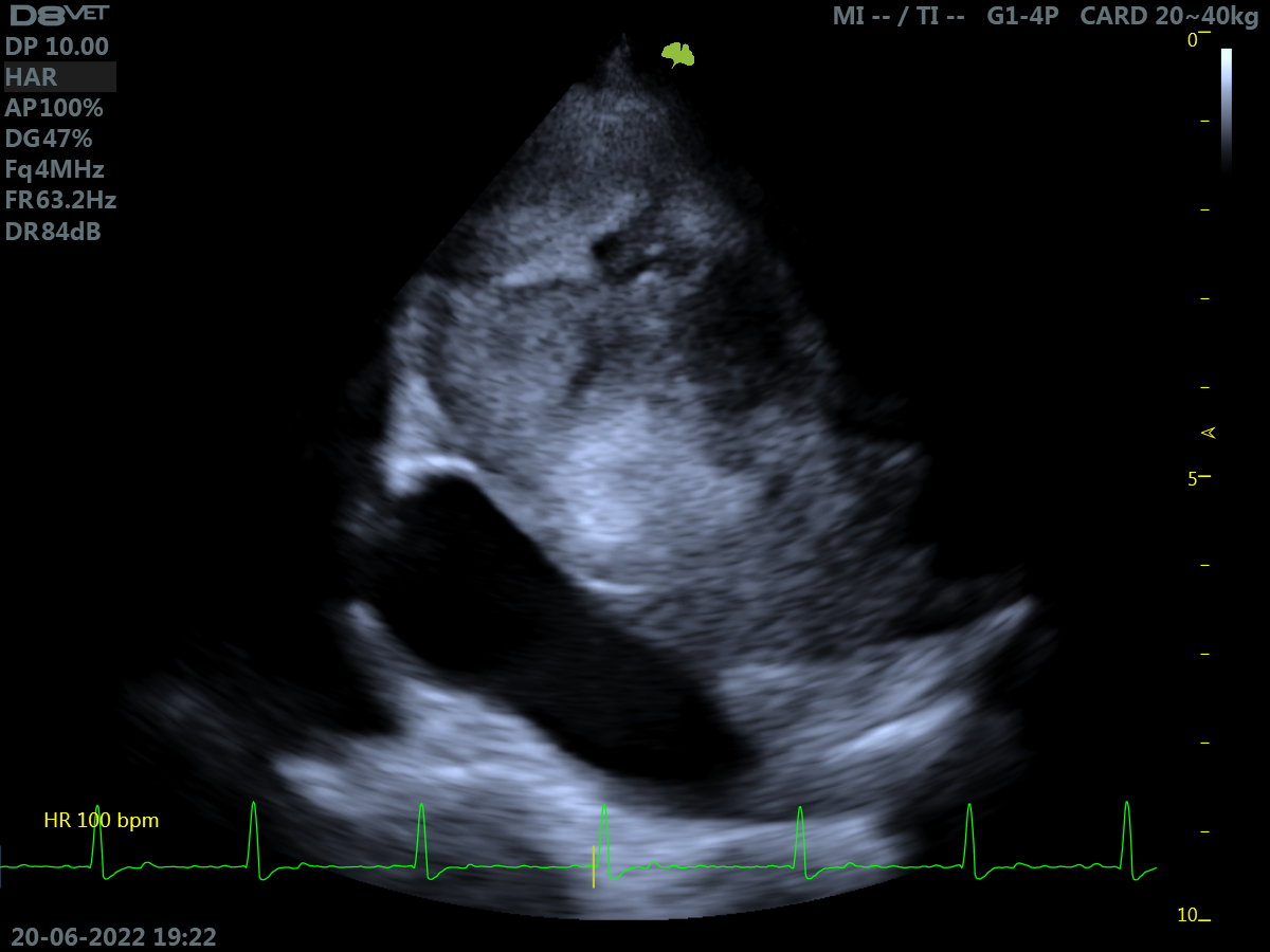 Foto 3 - esempio di neoformazione cardiaca di grandi dimensioni Image