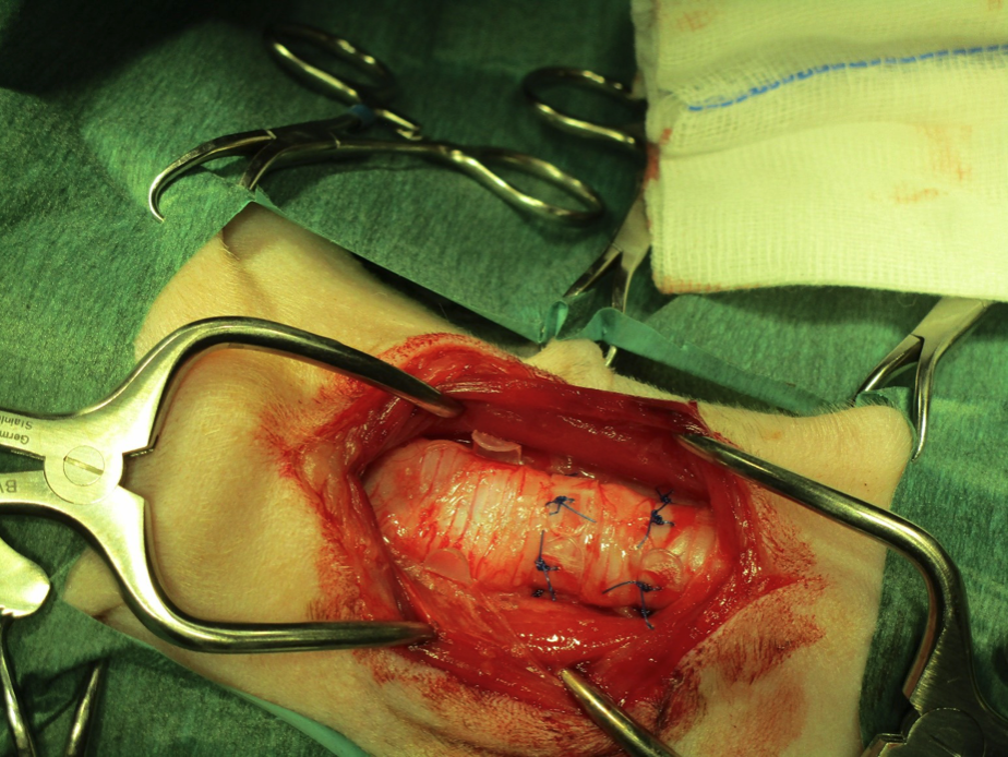 Fig. 4 - Applicazione chirurgica di protesi anulari extratracheali. Image