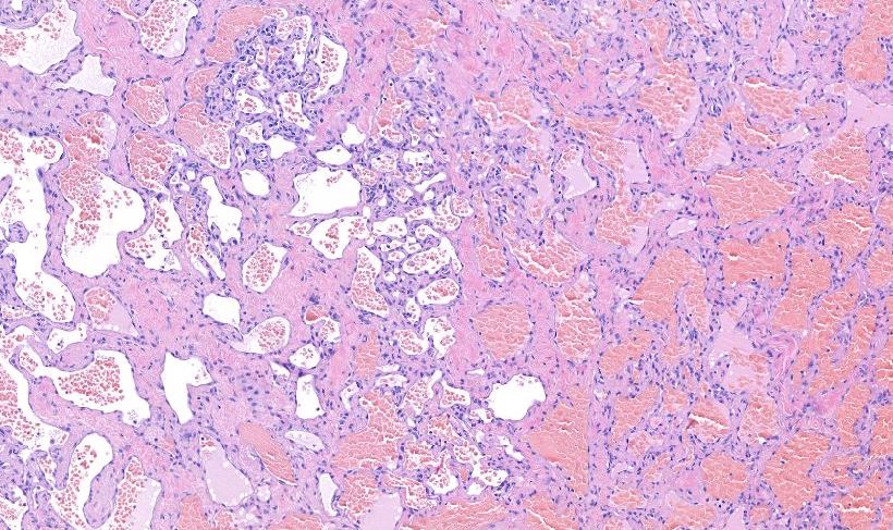 Fig. 1 - Emangioma cutaneo Image