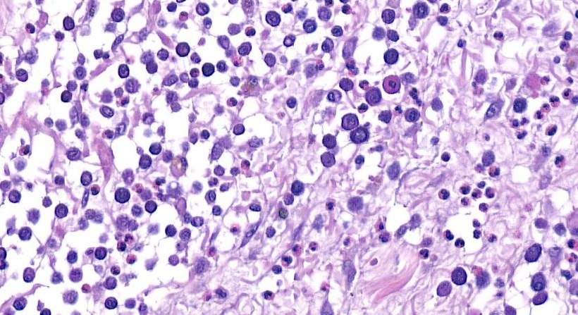 Fig. 2 - Mastocitoma Image